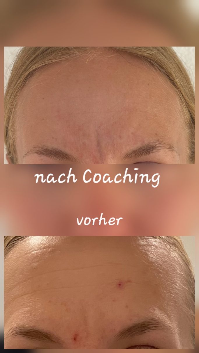 Vorher Nachher Bild Akne an Stirn