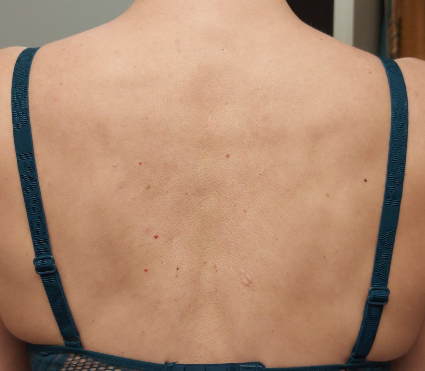 Rücken Nachher Rücken Nachher