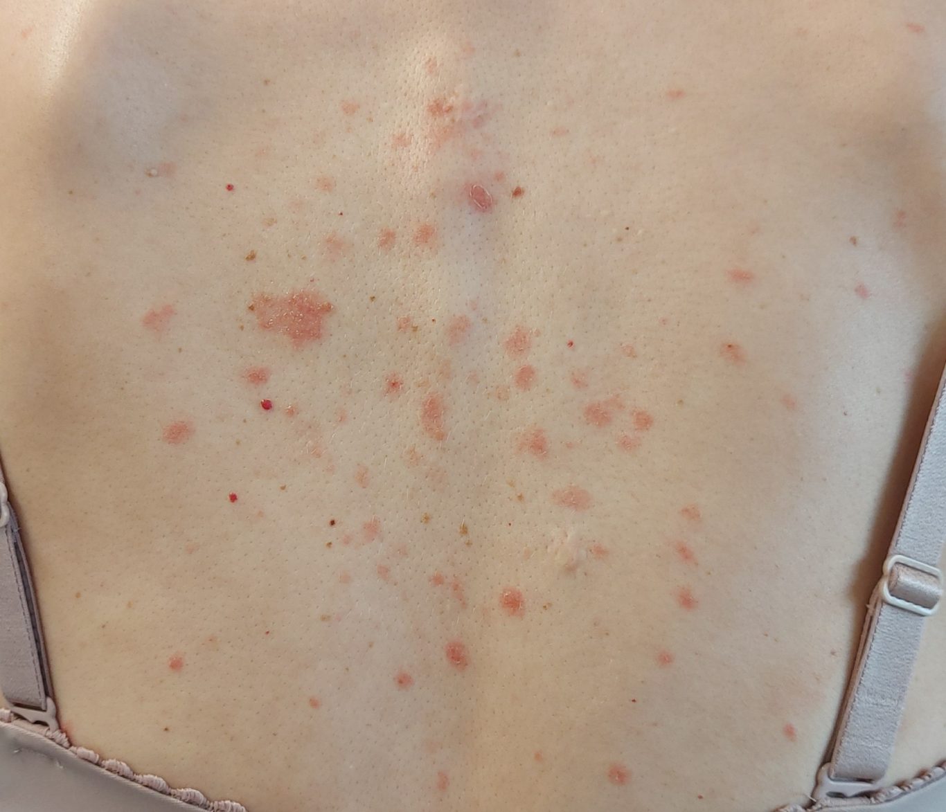 Rücken Vorher Rücken Vorher