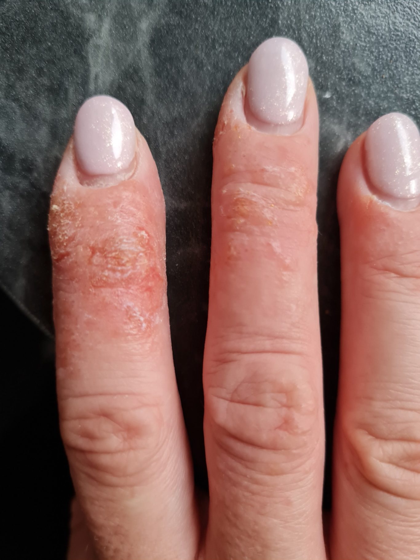 Hautzustand vorher Hautzustand vorher