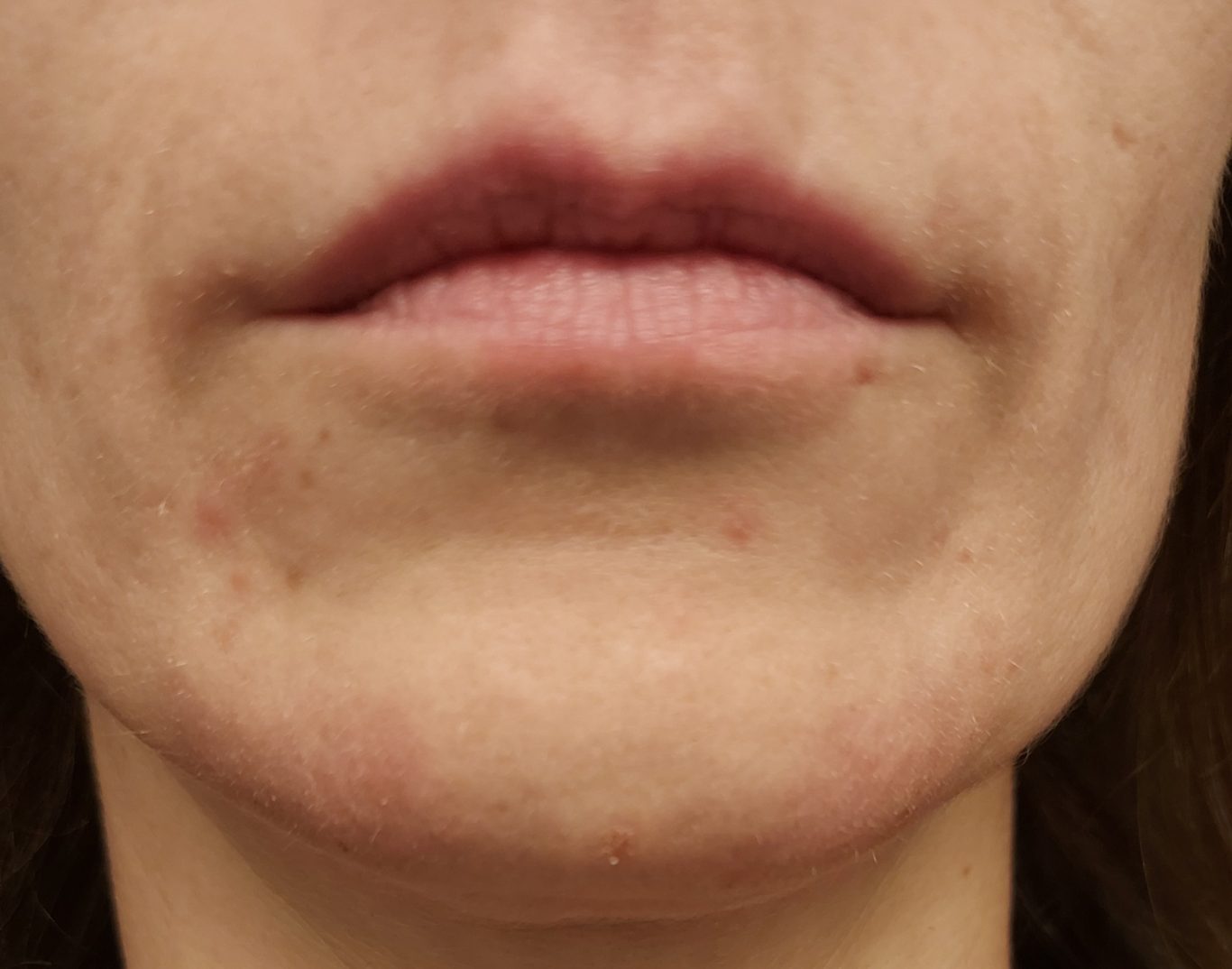 Kinn Nachher Kinn Nachher