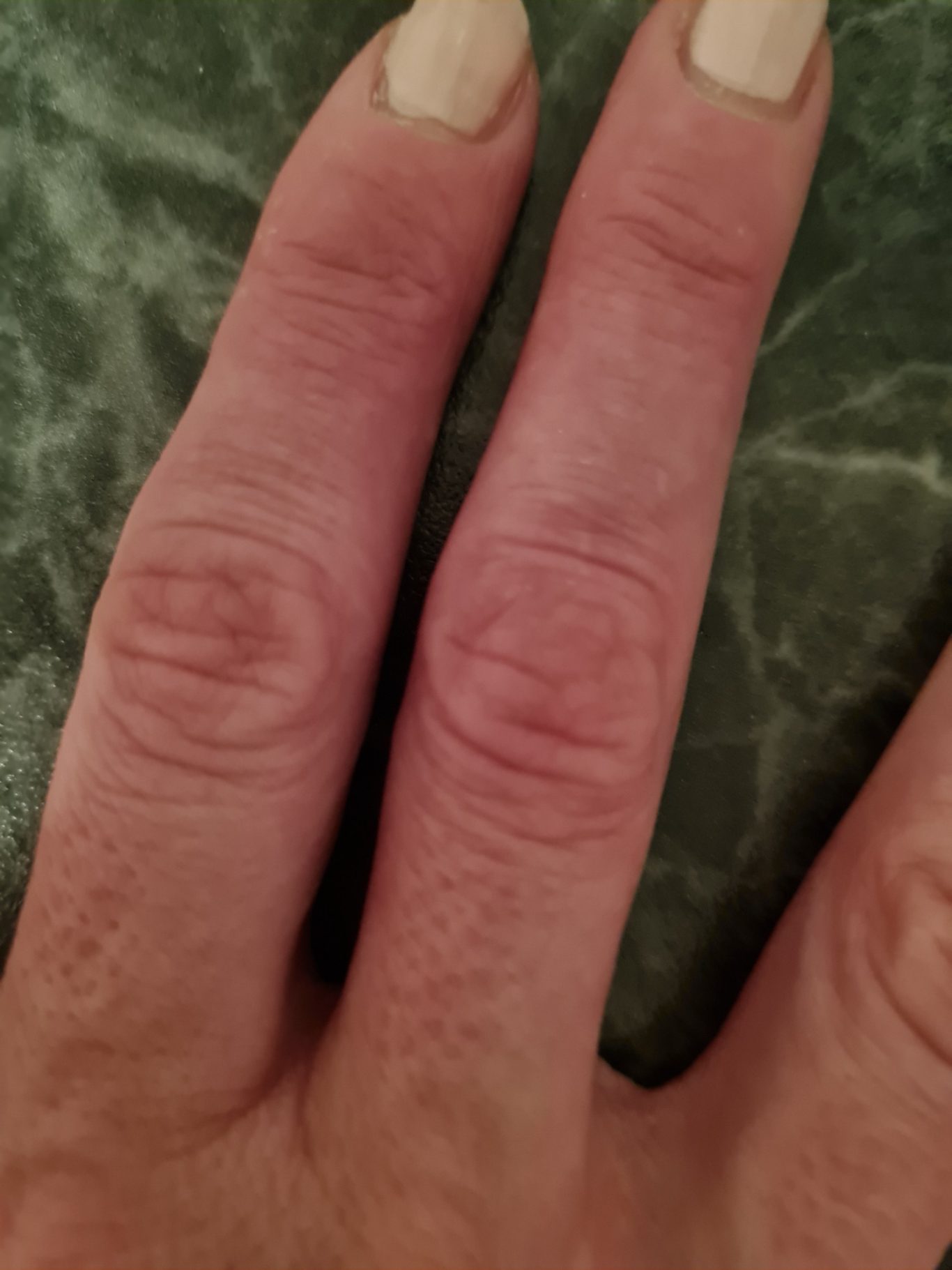 Hautzustand nachher Hautzustand nachher