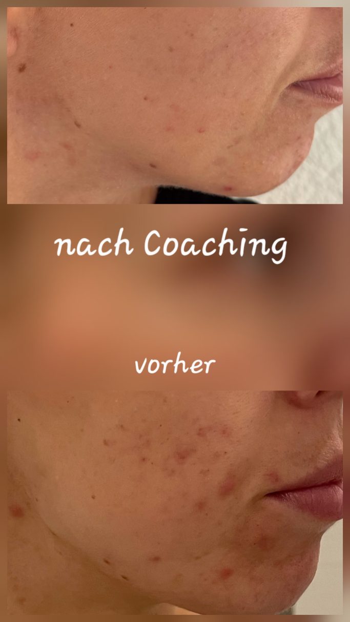Vorher Nachher Bild Akne an Wange