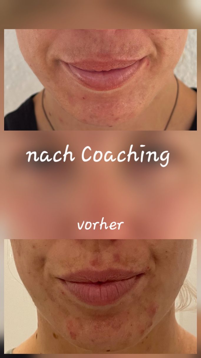 Vorher Nachher Bild Akne am Kinn