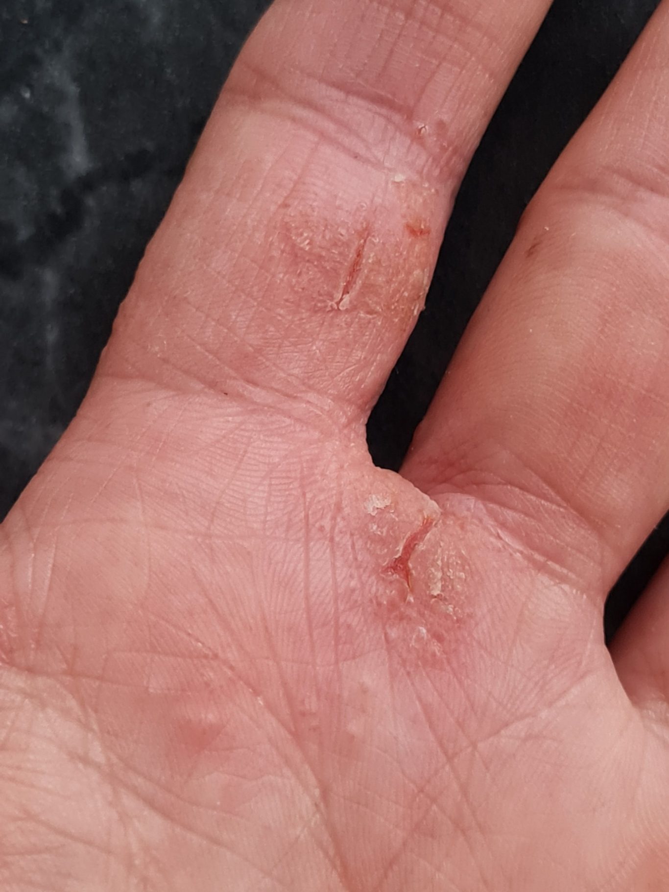 Hautzustand vorher Hautzustand vorher